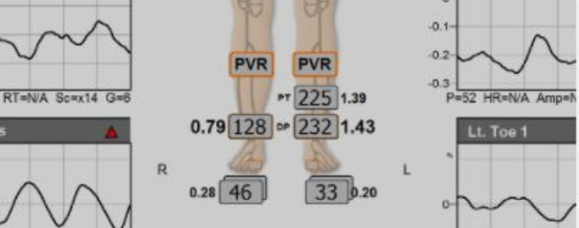 Vascular Evaluation in Patients with Lower Extremity Ulceration
