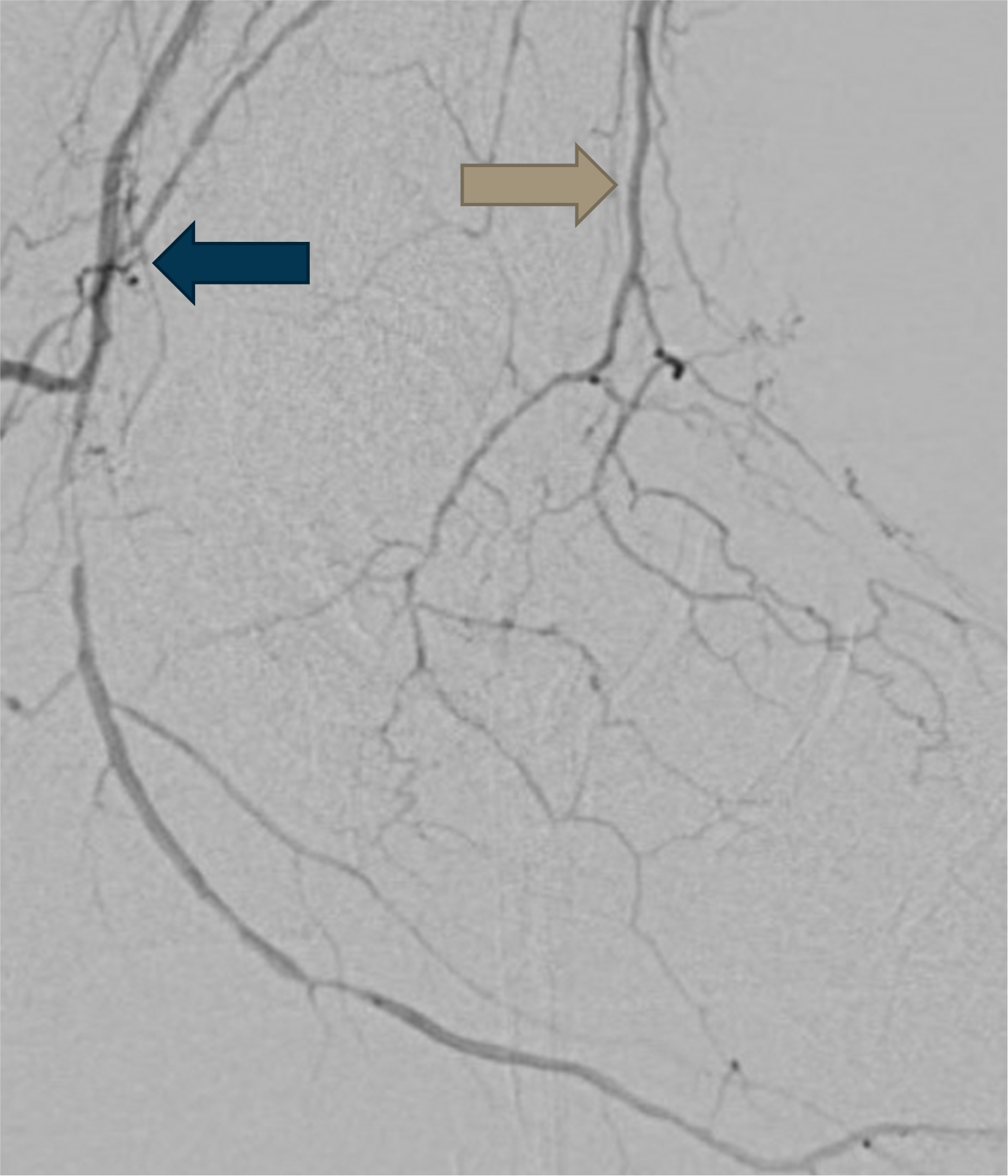 Figure 3. Angiogram showing occlusion of the common plantar artery and dorsalis pedis artery. The PTA and ATA pulses were palpable.