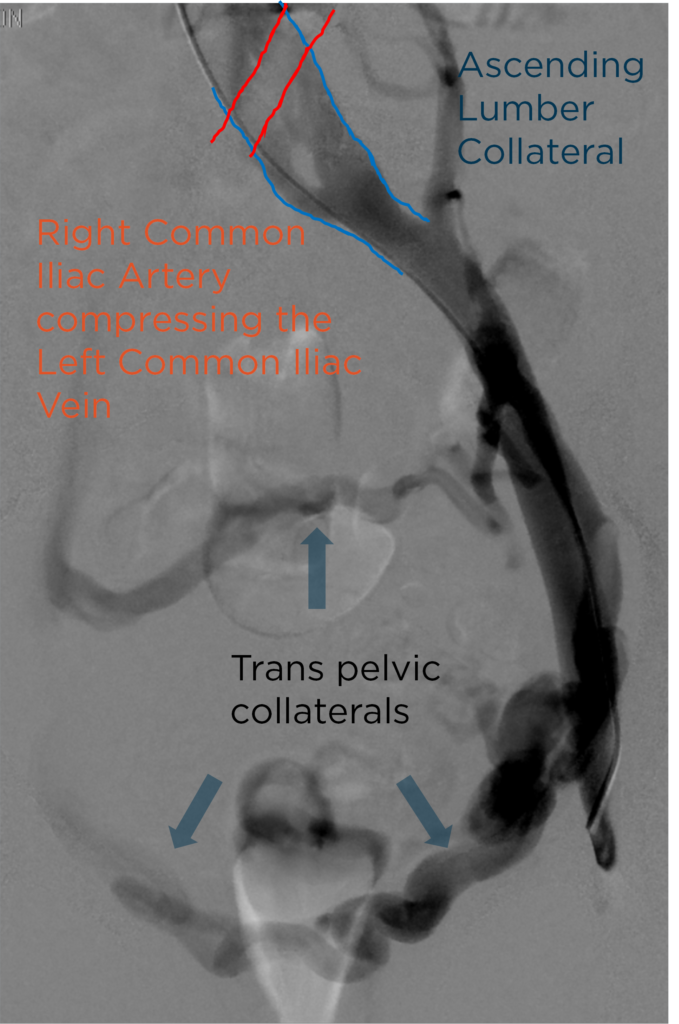 Figure 5. Venography showing severe compression of the left common iliac ven by the right common iliac artery.