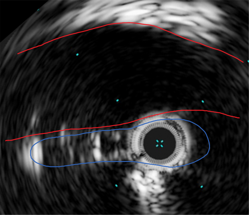 Figure 6. Intravascular ultrasound showing severe compression of the left common iliac vein (blue) by the right common iliac artery (red).