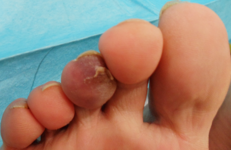 Blue Toe from Ulcerated Popliteal Artery Plaque