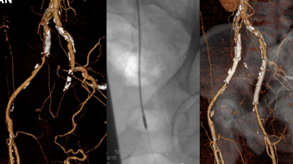 Endovascular Treatment of EIA and CFA Occlusions