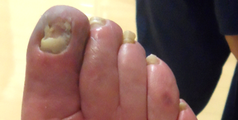 Misdiagnosed Painful Toe