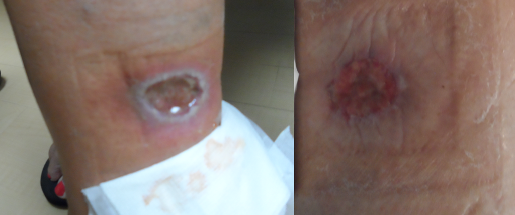 Non-Healing Ulcer After Skin Biopsy