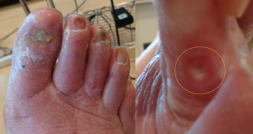 Painful Right Toe