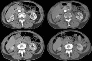 images top left to bottom right show tumor resolution over 2 years