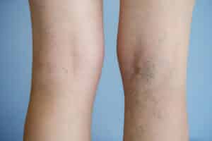 Painful varicose veins (spider veins, varices) on an affected leg.